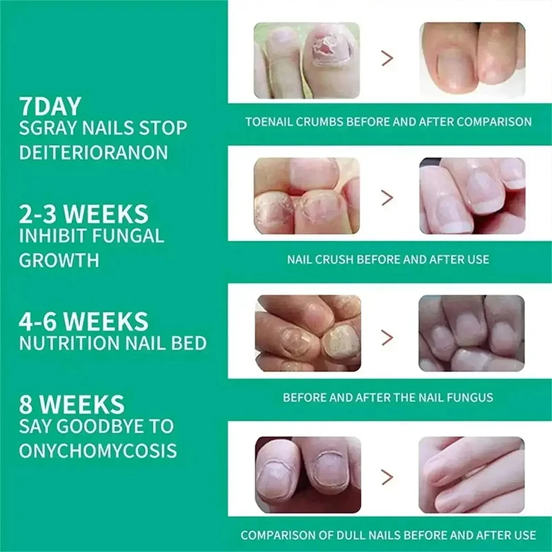 7Days Nail Fungus Treatment Serum Ginger Anti-infective Paronychia Onychomycosis Toe Foot Nail Fungal Repair Gel Hand Foot Care