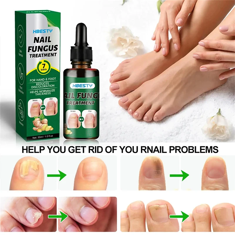 7Days Nail Fungus Treatment Serum Ginger Anti-infective Paronychia Onychomycosis Toe Foot Nail Fungal Repair Gel Hand Foot Care