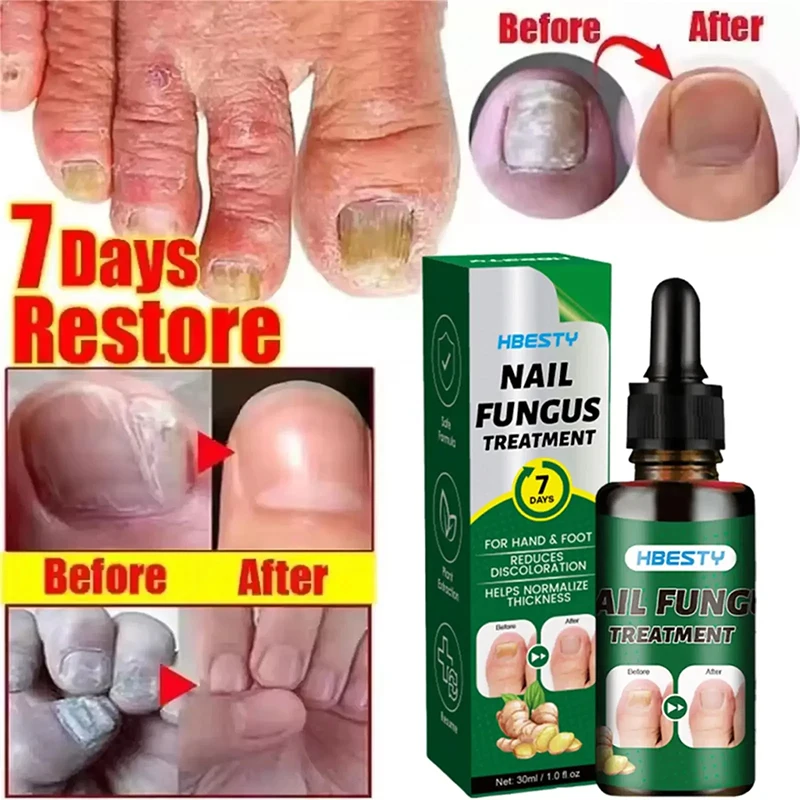 7Days Nail Fungus Treatment Serum Ginger Anti-infective Paronychia Onychomycosis Toe Foot Nail Fungal Repair Gel Hand Foot Care