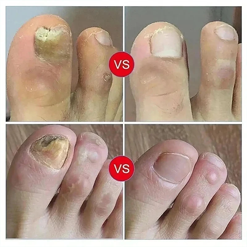 7Days Nail Fungus Treatment Serum Ginger Anti-infective Paronychia Onychomycosis Toe Foot Nail Fungal Repair Gel Hand Foot Care