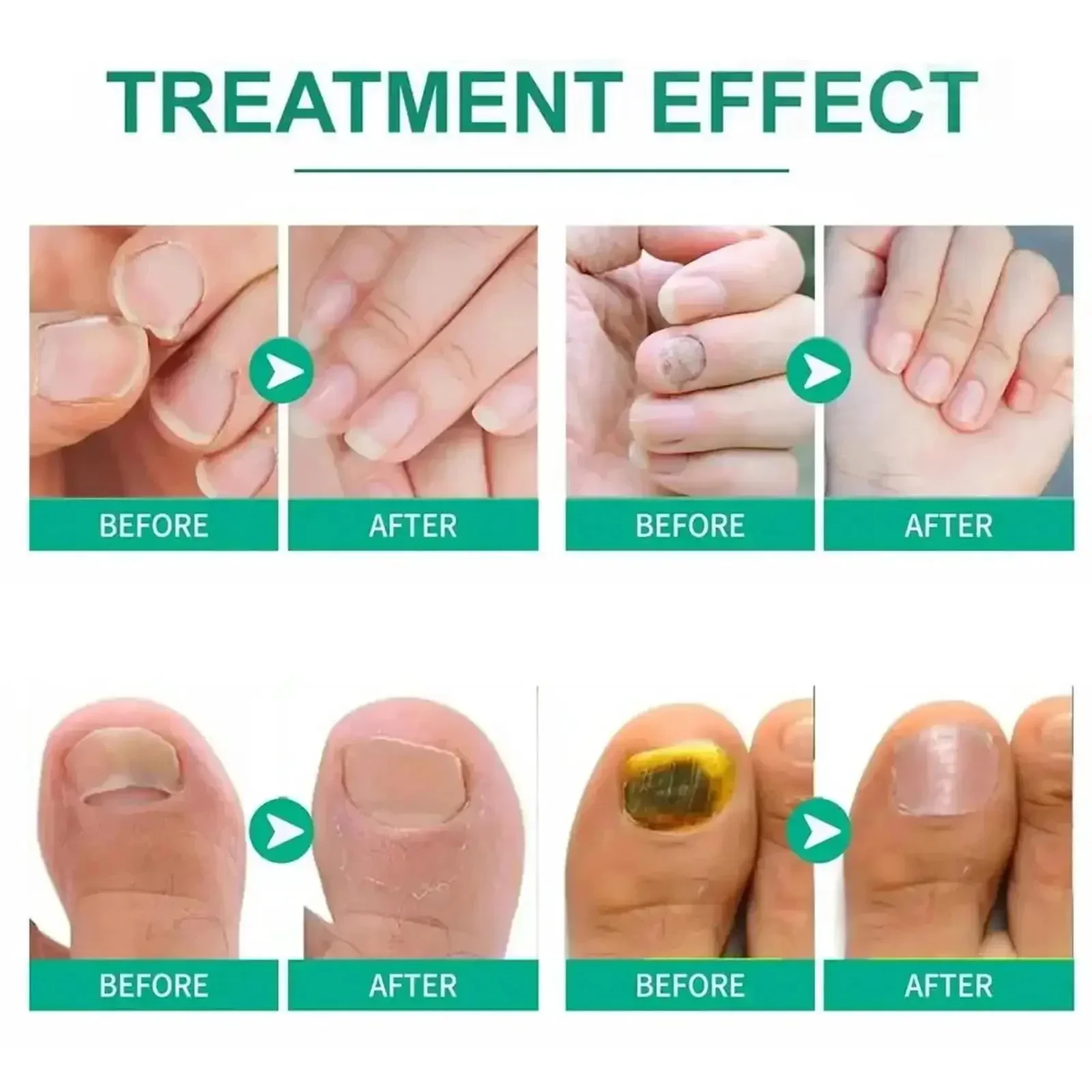 7Days Nail Fungus Treatment Serum Ginger Anti-infective Paronychia Onychomycosis Toe Foot Nail Fungal Repair Gel Hand Foot Care