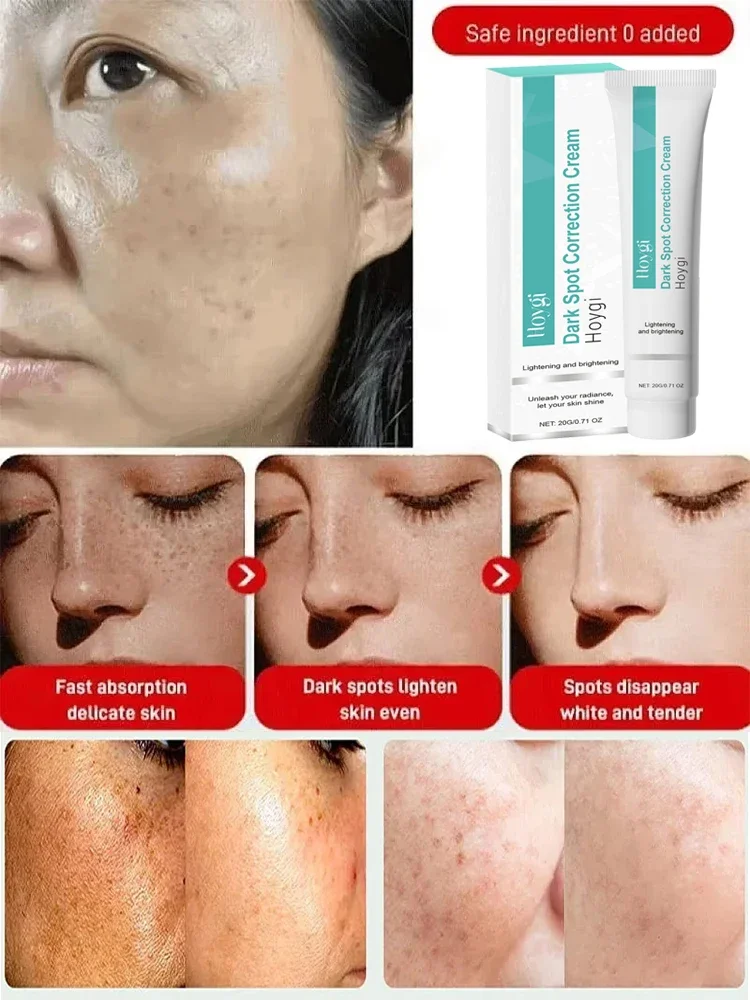 Powerful Spot-removing Whiten Cream Brighten Skin Fast Eliminates Melanin Pigmentation Melasma Dark Spots Moisturize Beauty Gel