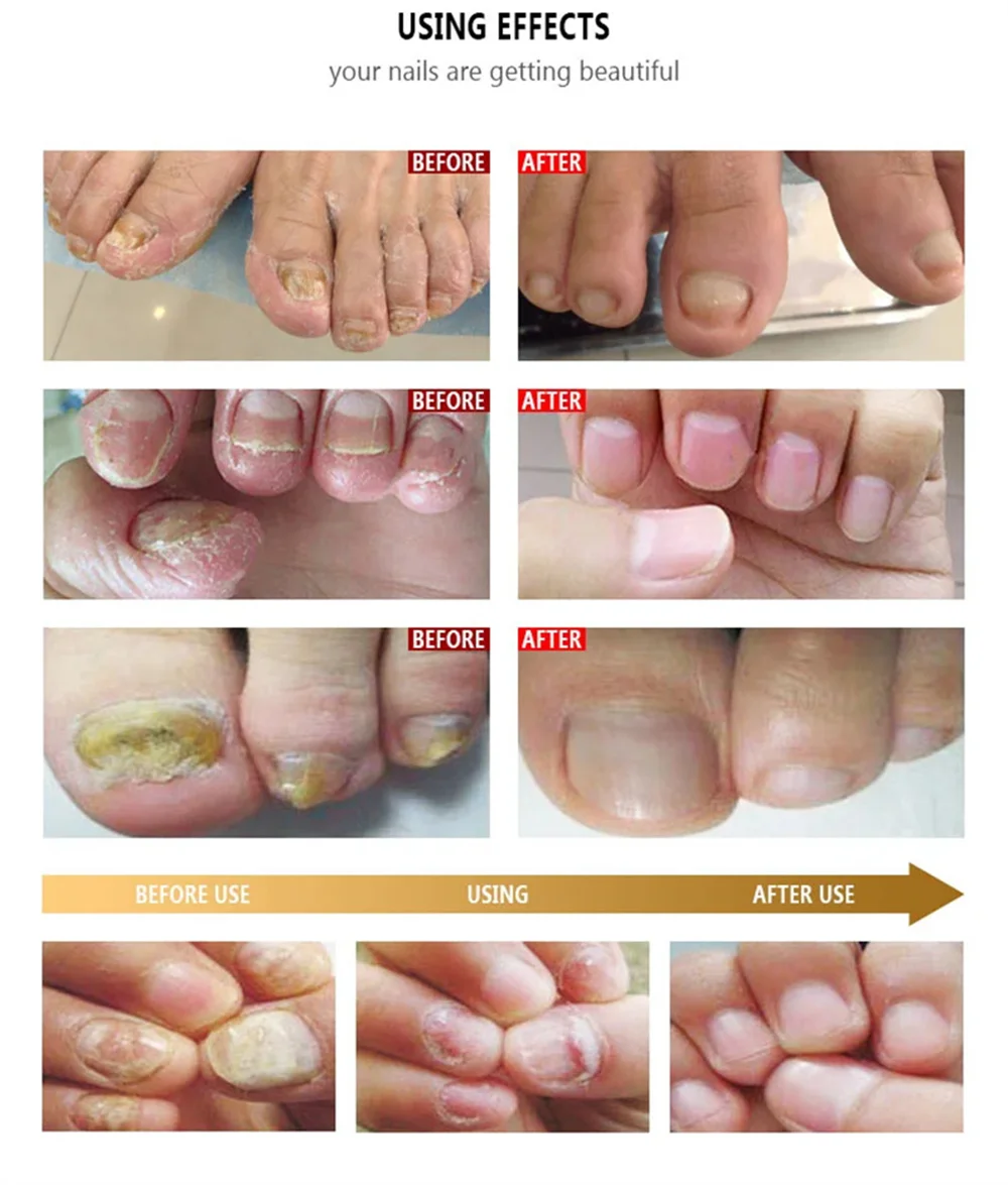 Fungal Nail Treatment Serum Nails Fungus Removal Treating Paronychia Liquid Anti Gray Nails Toe Infection Foot Repair Care Tools