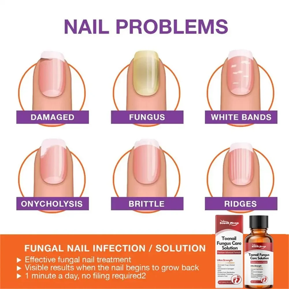 Fungal Nail Treatment Serum Nails Fungus Removal Treating Paronychia Liquid Anti Gray Nails Toe Infection Foot Repair Care Tools