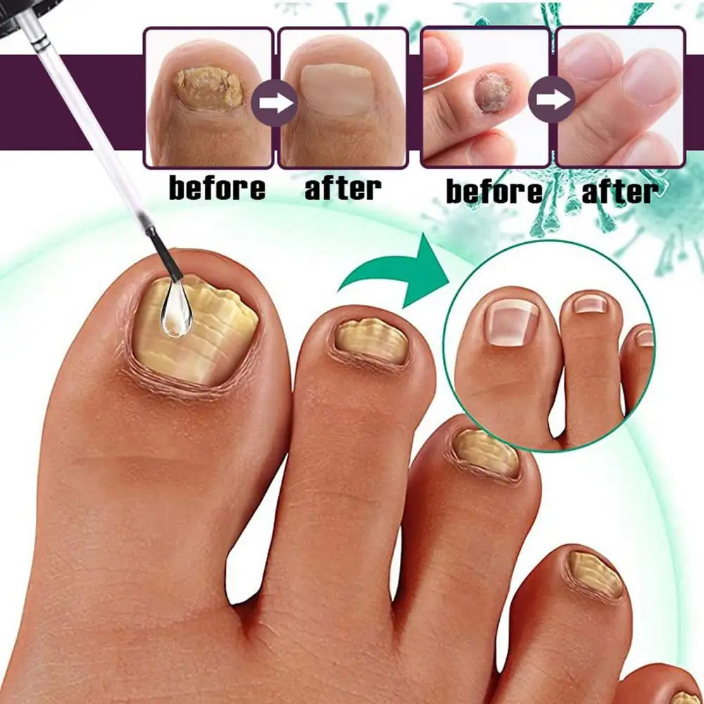 Fungal Nail Treatment Serum Nails Fungus Removal Treating Paronychia Liquid Anti Gray Nails Toe Infection Foot Repair Care Tools