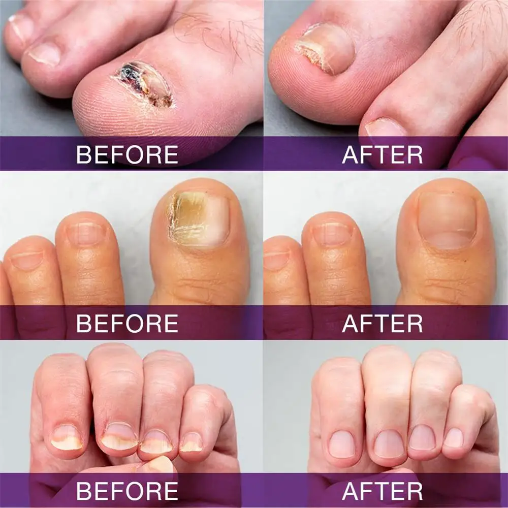 Fungal Nail Treatment Serum Nails Fungus Removal Treating Paronychia Liquid Anti Gray Nails Toe Infection Foot Repair Care Tools