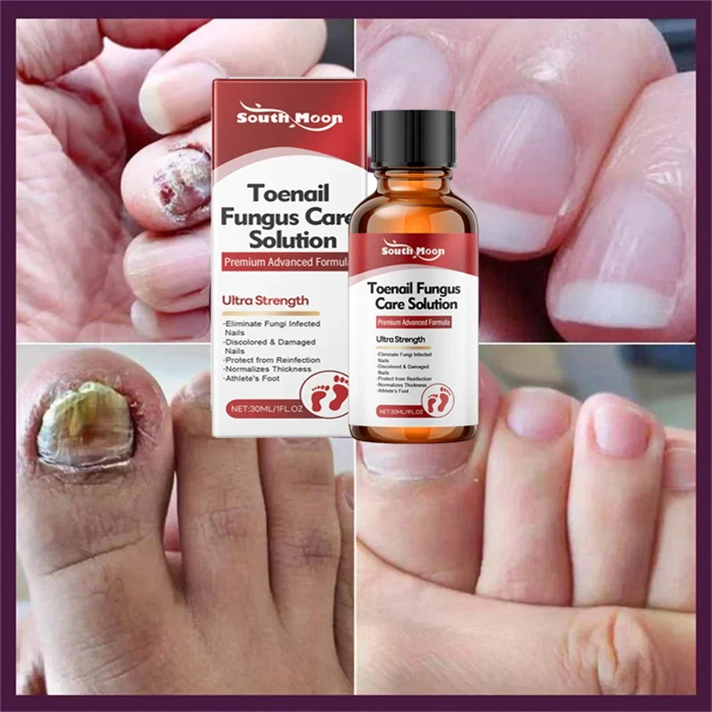 Fungal Nail Treatment Serum Nails Fungus Removal Treating Paronychia Liquid Anti Gray Nails Toe Infection Foot Repair Care Tools