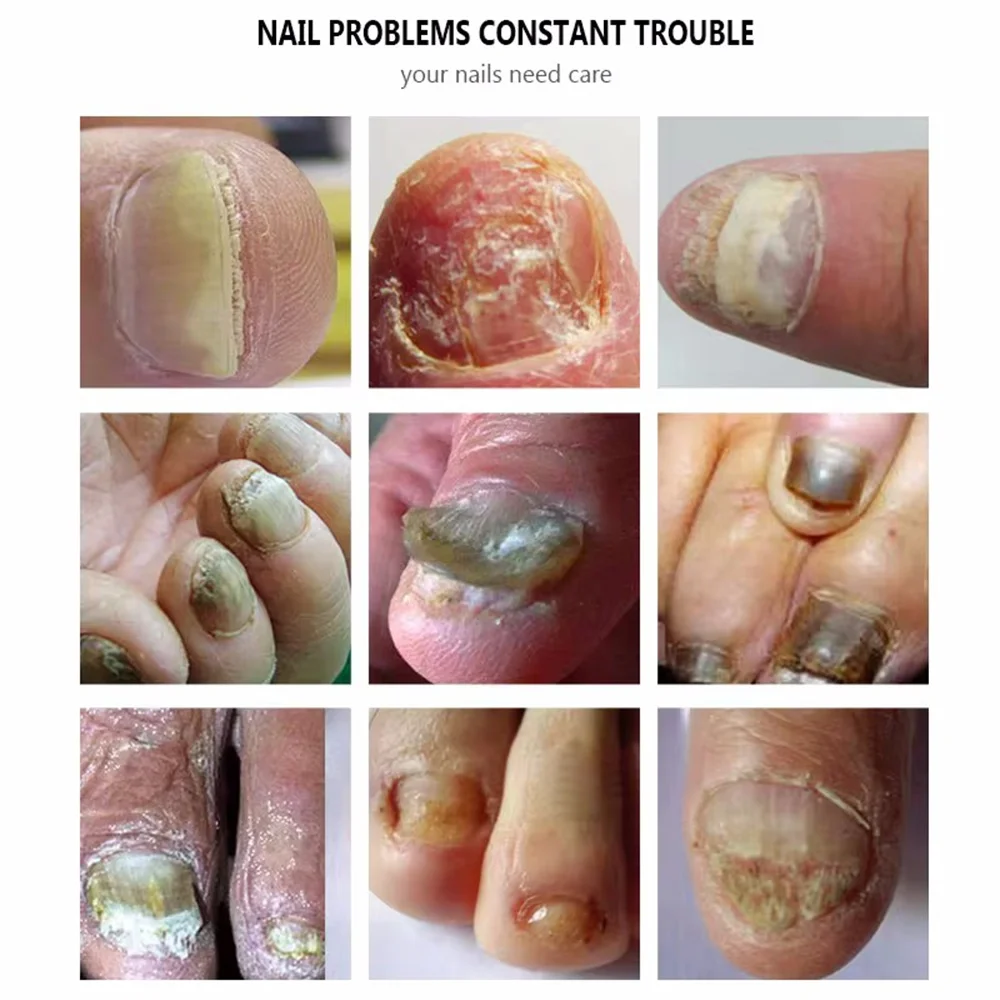 Fungal Nail Treatment Serum Nails Fungus Removal Treating Paronychia Liquid Anti Gray Nails Toe Infection Foot Repair Care Tools