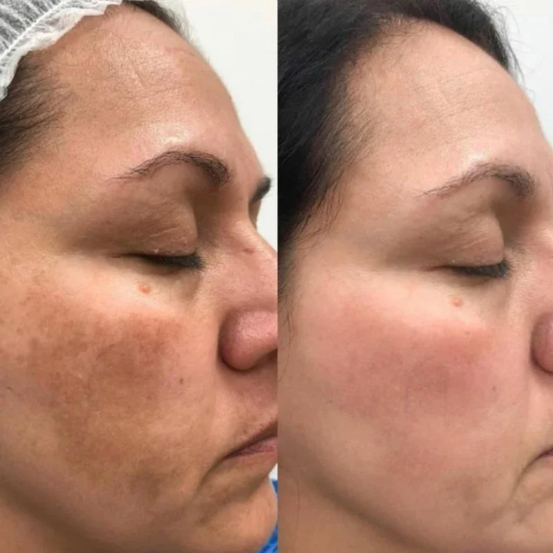 Hoygi Niacinamide Facial Serum Vitamin B3 Wrinkles Pigment Dark Spot Removal Correcting Glow Serum Face Whitening Moisturizer