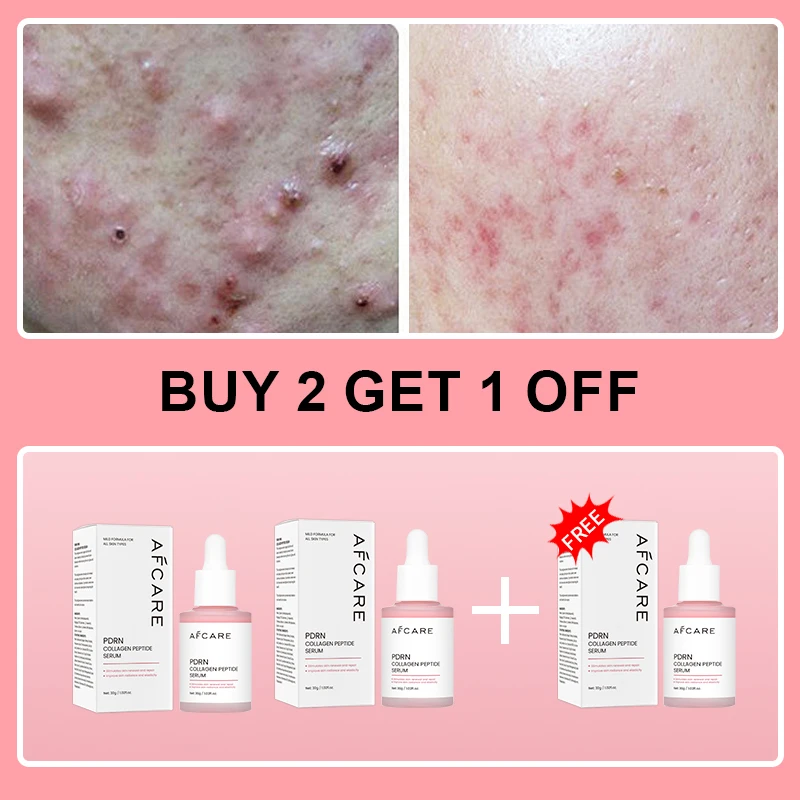 Complex Peptide Acne Serum PDRN Collagen Shrink Pores Fade Melanin Smooth Brightening Skin Korean Skincare Products